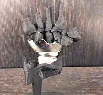 Field Orthopaedics' wrist replacement features a three-part magnetic coupling.